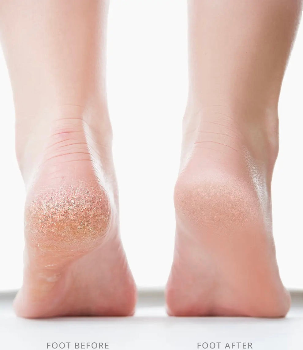 SilkSolePro™- Electric Feet Callus Remover